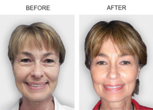 Laser Face Treatment