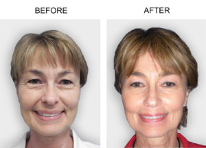 Laser Face Treatment